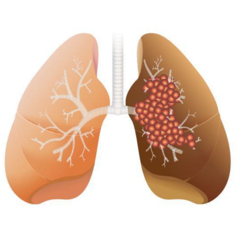 Wysoka dawka NMN hamuje wzrost gruczolakoraka płuc