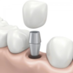 Implant dentystyczny