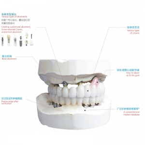 Implant dentystyczny